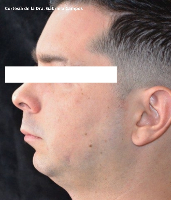 imagen caso de antes: Rostro antes del tratamiento con relleno dérmico MONALISA de ácido hialurónico.