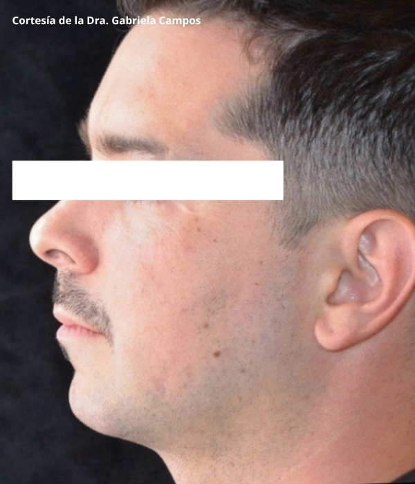 Resultados visibles tras la aplicación del relleno dérmico MONALISA en zonas faciales.