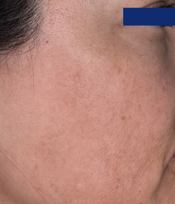 Resultados posteriores al tratamiento con Renvix, piel más firme y luminosa y cabello más denso y fortalecido